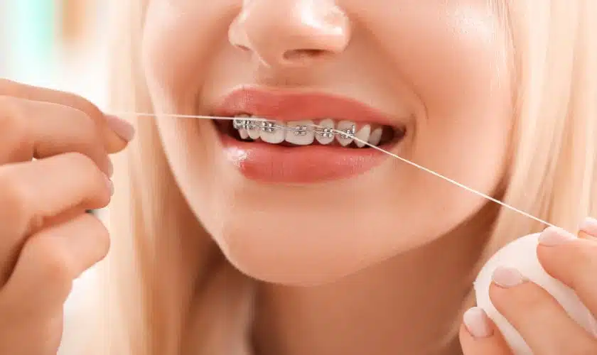 How To Floss With Braces?