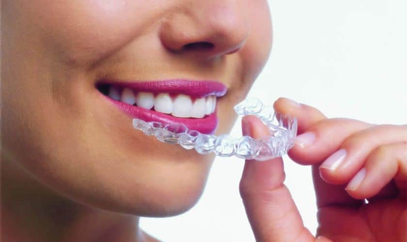 Does Invisalign Work With Braces?