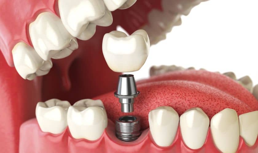 dental implant Tulsa