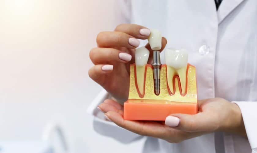 The Dental Implant Process: Step-By-Step Guide For Patients