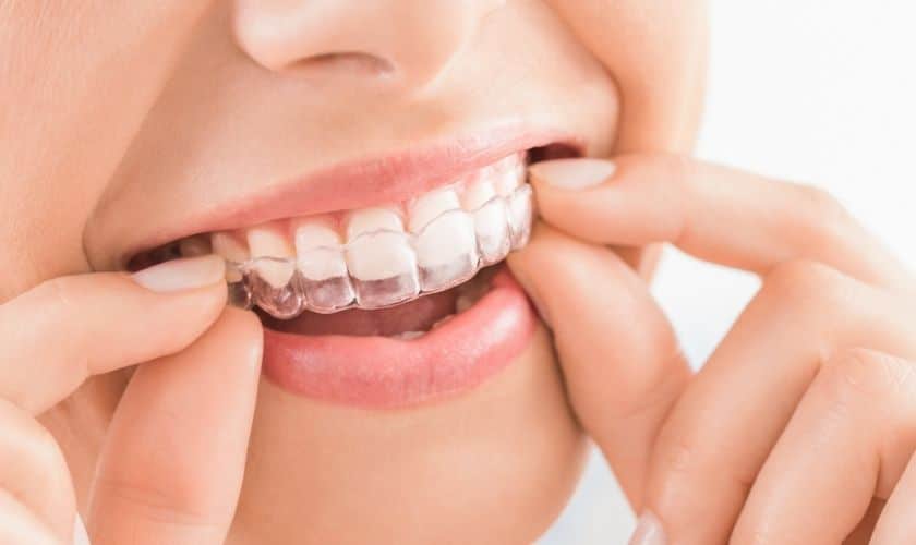 Modern Approach By Use Of Invisalign In Tulsa
