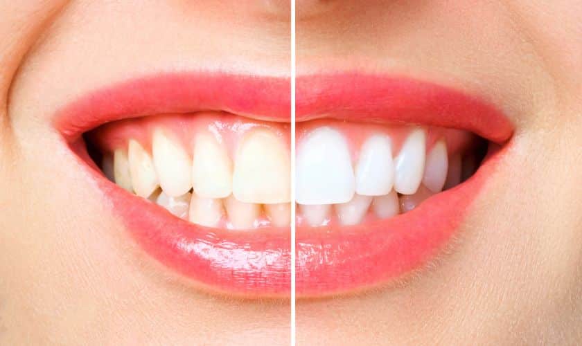 The Ultimate Guide To Teeth Whitening Techniques