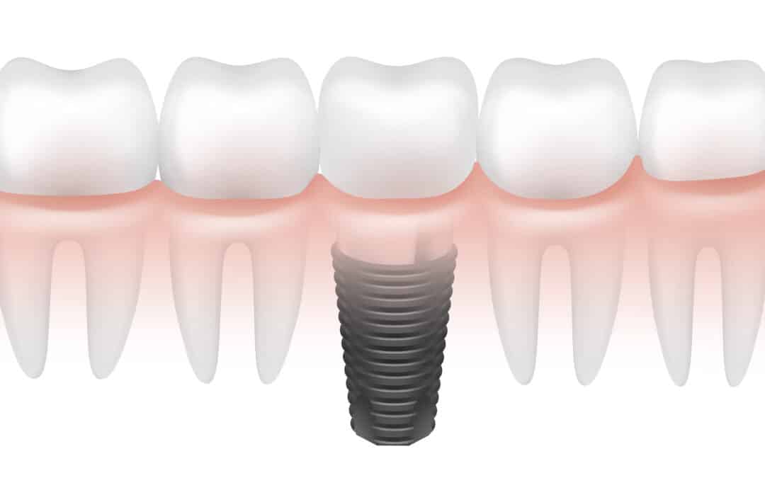 How Dental Implants Can Transform Your Appearance?