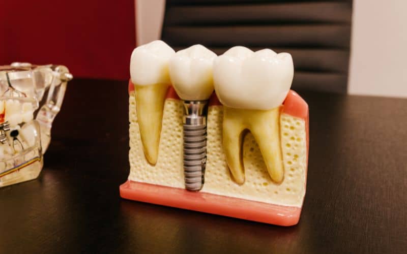 5 Myths About Dental Implants Debunked
