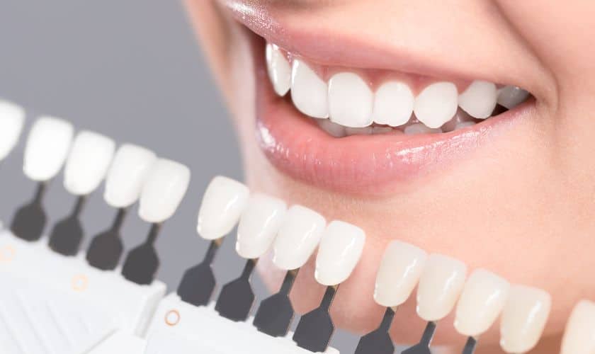 How to Maintain Your White Smile: Post-Whitening Care Tips
