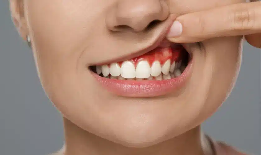 Understanding Gum Disease: Causes, Symptoms, and Risk Factors