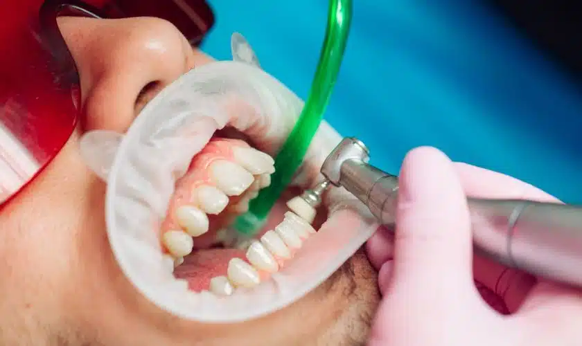 How Often Should Teeth Cleaning Be Done?